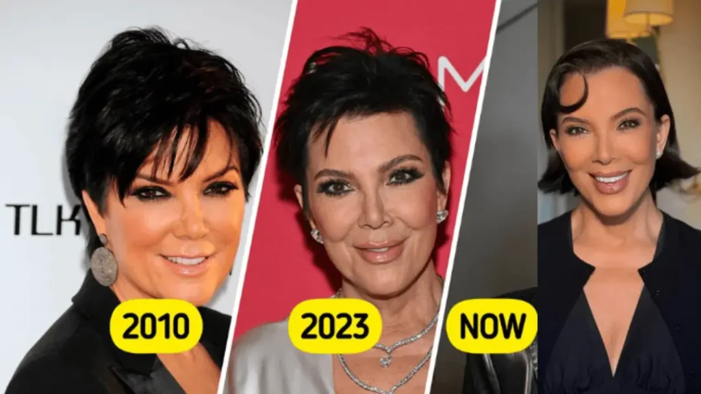 kris jenner face lift